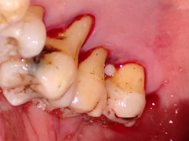 Figure 1: Pre-operative view showing enamel pearl.