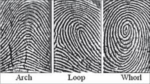 Figure 1: Fingerprints. Loops: It is the most common pattern on the fingertip.6 65% of the population posses loops.9 A series of ridges enter the pattern area on one side of the digit, recurve abruptly, and leave the pattern area on the same side. **Types of loop:** Depending on the side where the loop opens it is classified as: a) **Ulnar loop:** when the loop opens on the ulnar side and account for 60% of the loops. b) **Radial loop:** when the loop opens towards the radial margin and account for 5%. **Whorls:** It is any ridge configuration with two or more triradii. One triradius is on radial and the other on the ulnar side of the pattern. Henry (1937) limited the designation of the term 'Whorl' to those configurations having ridges that actually encircle a core. **Arches:** 5% of population has them.9It is the simplest pattern found on the fingertips. It is formed by succession of more or less parallel ridges, which transverse the pattern area and form a curve that is concave proximally. Sometimes the curve is gentle while at other times it swings sharply so that it may be designated as low or high arch respectively [6].