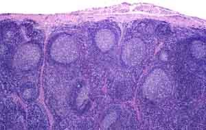 Figure 3: Cortical germinal centres with a capsule.