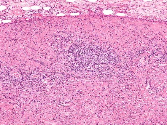 Figure 4: Kikuchi's disease with neutrophilic clusters.
