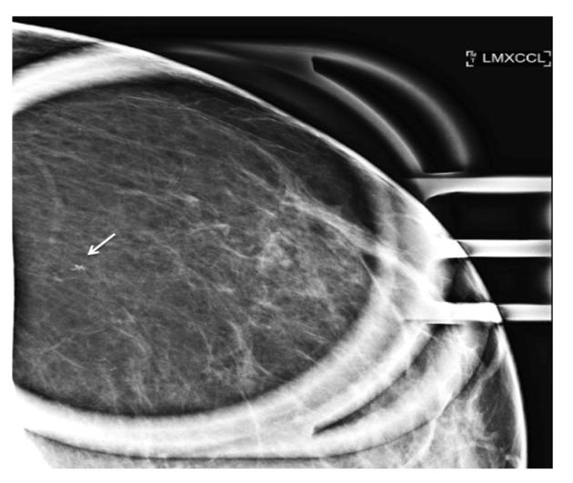 Figure 1: Spot magnification with cranio-caudal view of the left breast showing 2mm area of calcifications located at 1 o’clock, posterior depth (white arrow).