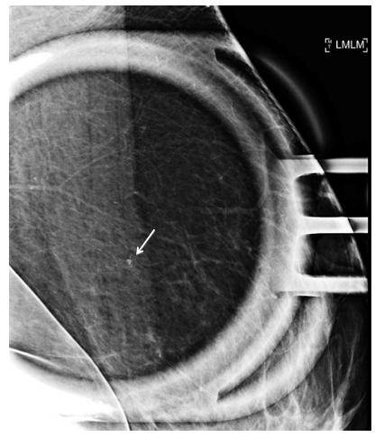 Figure 2: Additional left breast spot magnification with lateromedial view showing the same 2mm group of calcifications (white arrow), with coarse and heterogeneous morphology concerning for malignancy. Given BIRADs grading of 4b.