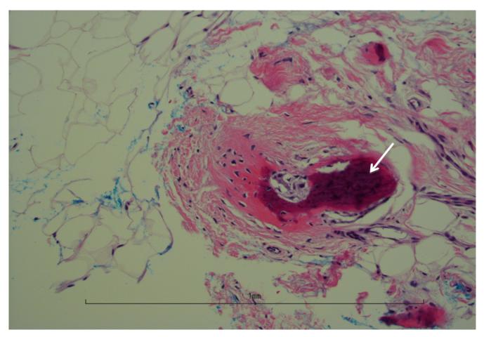 Figure 3: Results were communicated to the patient and no additional follow-ups were scheduled. The patient was advised to return to her normal annual mammographic screening schedule.