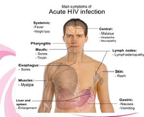 Figure 2: Symptoms of HIV Symptoms of HIV.