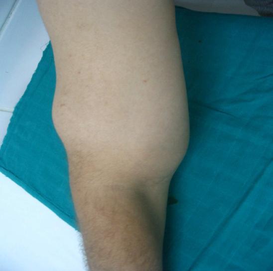 Figure 1: The physical examination showed a mass about 15-8-6 cm from the right arm.