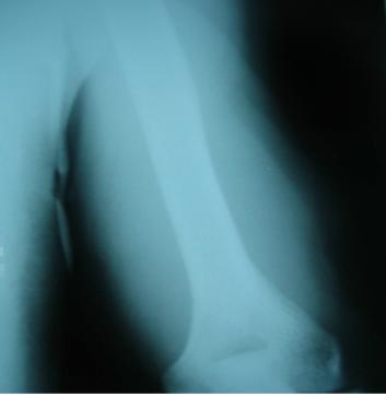 Figure 2: X-rays showed swelling of soft tissues, without calcification.
