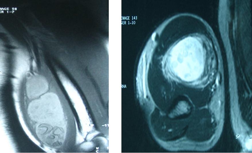 Figure 3: Presence of small hyposignal cysts on the surrounding parts of the mass.