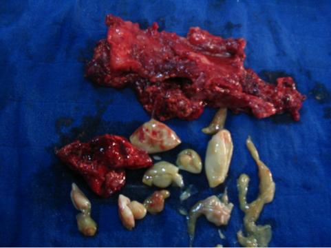 Figure 4: Clinical appearance of the hydatid cyst after resection with the cysts children.