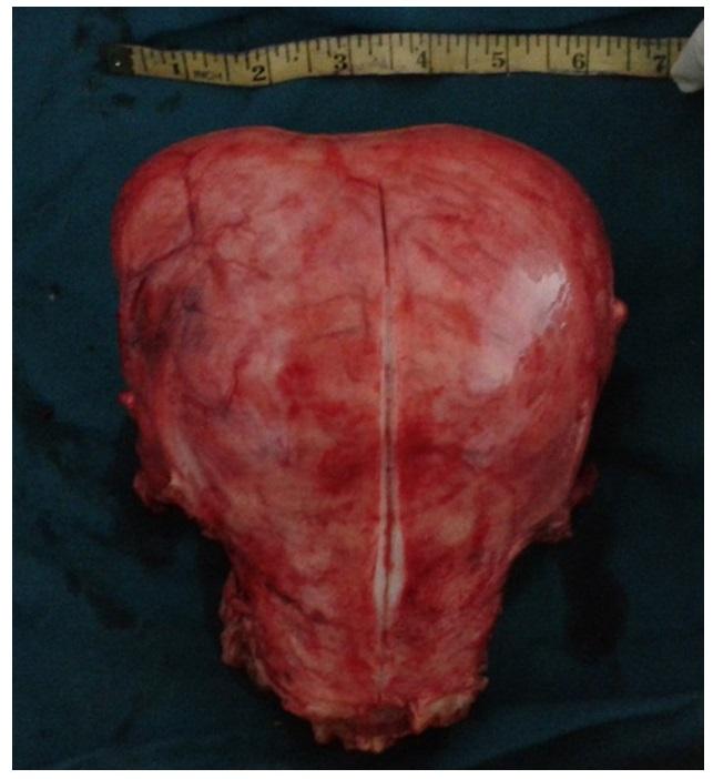 Figure 2: Gross view of tumour mass. Patient withstood the surgery well with no intra operative complications. On postoperative day 7 patient developed hematuria. On ultrasound study, organized hematoma was found in bladder. Cystoscopy guided bladder wash was given and symptoms were relieved. On day 9 of surgery complete suture removal was done. Wound healthy. Patient was discharged in healthy condition .Final Histopathology report confirmed the diagnosis of uterine carcinosarcoma (malignant mixed mullerian tumour of uterus ) The tumour is seen involving more than half thickness of myometrium and is reaching up to the cervix with involvement of cervical stoma. There was no evidence of tumour involvement of bilateral ovaries. One ovary shows endometriosis with simple cyst. The second ovary is unremarkable. Now patient is receiving adjuvant chemotherapy cycles.