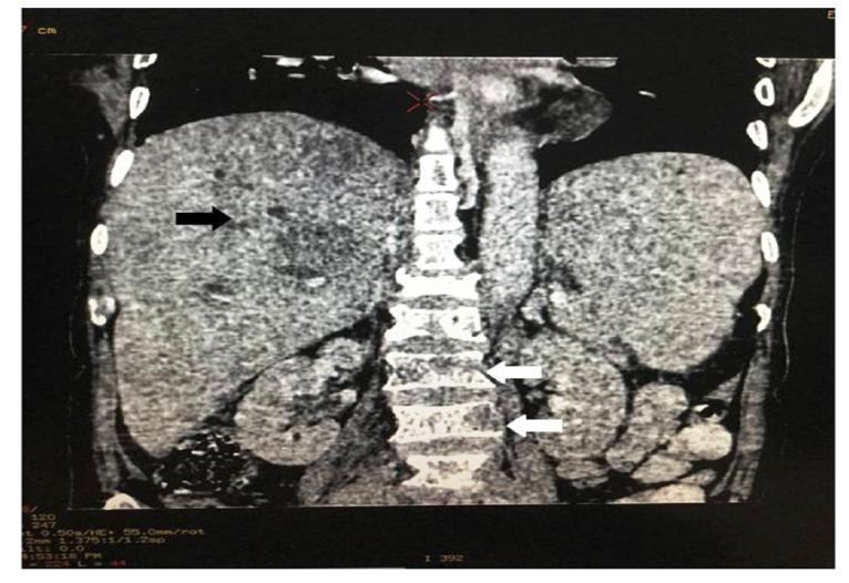 Figure 2: Contrast enhanced MDCT coronal section of carcinoma gallbladder (black arrow) presenting with multiple osteolytic vertebral metastases (white arrow).
