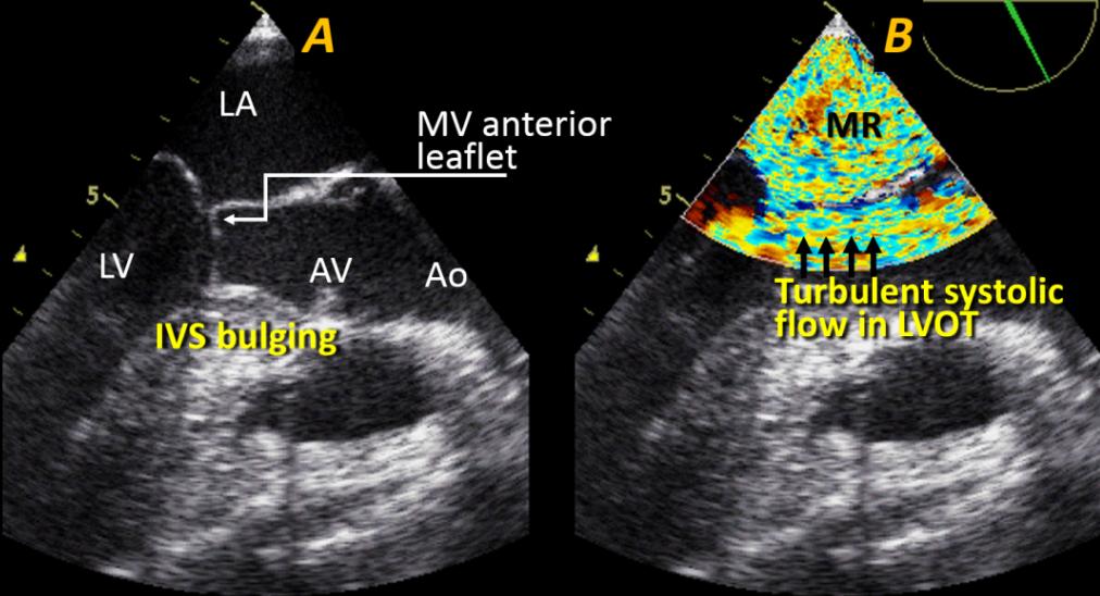 Figure 1: Standard hemodynamic monitoring. All patients were monitored with invasive arterial pressure (AP), PAC (before and/or just after LVOTO diagnostics) to control pulmonary arterial pressure (PAP), pulmonary arterial wedge pressure (PAWP), and cardiac index (CI). Standard LVOTO therapy generally involves inotropic support cancellation, beta-blockers, fluid loading, and arterial hypertension induction by phenylephrine.