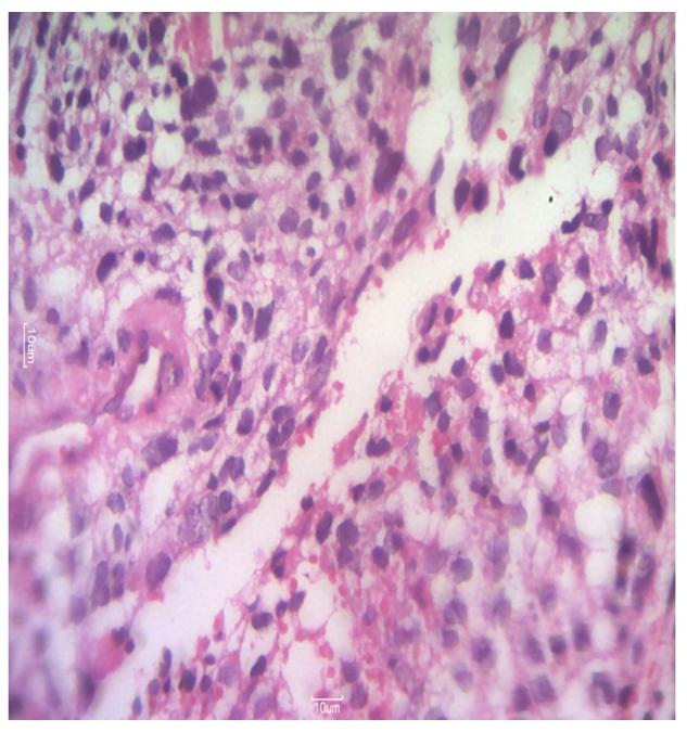 Figure 3: Desmin positive which confirmed the diagnosis.