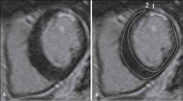 Figure 2: Example of a recognized myocardial infarction scar. (A) Delayed enhanced MRI in the short axis view showing delayed enhancement involving the subendocardial myocardium in the anterior wall of the left ventricle. (B) Signal intensity (SI) analysis of the myocardial scar. Two regions of interest (ROIs) were drawn to delineate the myocardial scar (ROI n.1) and the normal myocardium (ROI n.2). The scar has a total area of 2781.2 mm3, corresponding to 7.67% of the total left ventricle mass, and has a SI ratio of 7.58.
