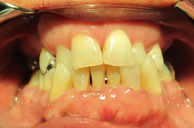 Figure 1: Intraoral photograph showing poor occlusion, cross bite, wear at incisal edges.