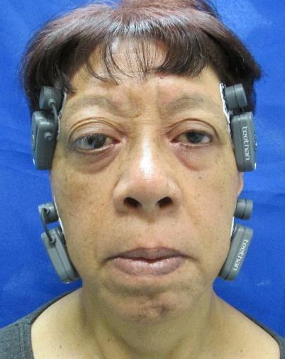 Figure 2: Anteroposterior photograph showing the placement of the surface electrodes. Bar graph showing greater activity in left temporal and masseter muscles.