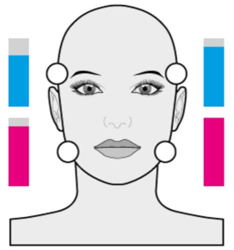 Figure 3: Application of botulinum toxin in left masseter and temporal muscle.
