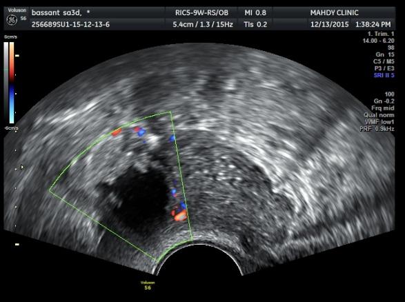 Figure 1: Doppler ultrasound of the affected ovary showing vascular complex mass.