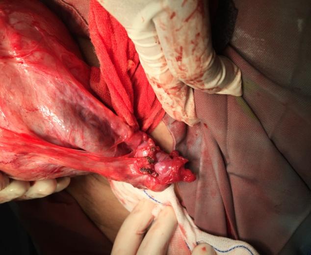 Figure 3: Right ovary after fertility preserving surgery during cesarean section.