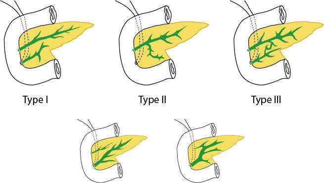 Figure 2: Variants of Pancreas Divisum.