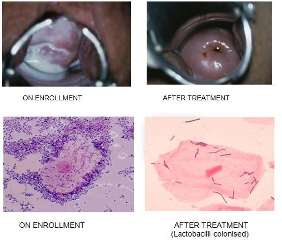 Figure 3: An illustrative representation of a typical woman receiving treatment with combination of microbicide and BASANT alone or along with Pro-vag-Health Probiotics strains [7].