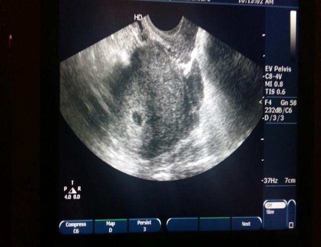 Figure 2: Hemoperitoneum and products of conception in the Pouch of Douglas as seen in laparoscopic examination. Follow up: Patient discharged in a satisfactory condition after 1 week with a confirmed intrauterine cardiac activity and increasing trend of B Hcg. Histopathology of adnexal tissue showed products of conception. Patient continued the pregnancy till term and went into spontaneous labor and delivered a female baby of 3.08kg at 39 weeks of gestation.