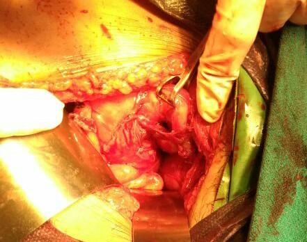Figure 4: Right tubal abortion and adhesions of the right tube (held with Babcock’s forceps) to bowel. Follow up: Patient was kept under observation for five days. She was discharged with a positive cardiac activity and an increasing trend of B Hcg. She was kept on progesterone support till 32 weeks as a precautionary measure. Pregnancy remained uneventful and she had a normal vaginal delivery of a 2.7 kg healthy male baby.