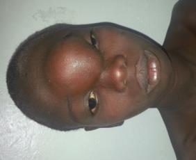 Figure 1: Left fronto-orbital tumefaction with ptosis. The ophthalmological examination revealed a reduction in the eye motion with a limited upward movement and a ptosis. Facial and Cranioencephalic TDM showed a cystic mass occupying the left frontal sinus. This cystic mass is homogeneous, well limited, blowing the sinus wall with osteolysis areas of the outer table (Figure 2) and it is also associated with bilateral maxillary sinusitis and ethmoid without parenchymal extension. The diagnostic hypothesis of a mucocele was asked. The cystic mass was removed by a first track of the brow Jacques under general anesthesia (Figure 3). After an incision of the upper left brow and detachment of subcutaneous flaps, we discover a lysis of the anterior wall of the frontal sinus and highlight a cystic mass in the left frontal sinus supraorbital. The spontaneous opening of the cystic mass was deaf left a thick mucoid whitish liquid. After suction of secretions, curettage of the mucocélique pocket we find a communication of both sinuses. The other walls of the frontal sinus in particular the posterior and inferior walls were unremarkable.