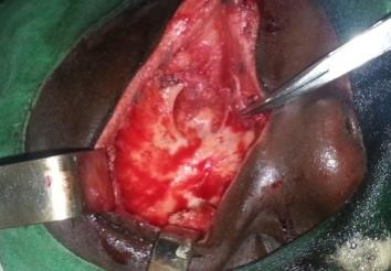 Figure 3: Per-operative image showing a ruptured cystic mass. Unclogging the nasal-frontal canal was conducted in order to ensure the ventilation and drainage of the frontal sinus. We performed the opening of the channel at the aid of a hemostat pliers placed in the nasal cavity with which it opens the meatus of nasofrontal channel as much as possible. A fatty wick was placed into the left frontal sinus, which is exited through the naso-front channel in homolateral nostril with the aid of pliers. An anterior nasal packing was placed. The postoperative care consisted in an antibiotic therapy (Ceftriaxone1g / day), corticosteroids 40mg / 24H and washing the sinus cavity with SSI 0,9% serum. The removal of the wick was performed at postoperative day 2. The postoperative course was uneventful. The patient was discharged on day 2. Histological examination of cystic pocket found a mucocele. Bacteriological research content was negative. On a decline of 6 months we have not noticed recurrence (Figure 4).