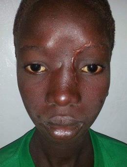 Figure 4: Immediate post-operative image 30 days later.
