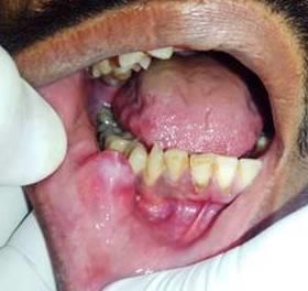 Figure 1: Solitary, well-circumscribed, oval-shaped swelling measuring about 0.5 to 1cm in its largest diameter with a smooth, shiny surface and having a slightly bluish hue present in relation to the lower right labial mucosa.