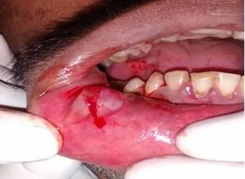 Figure 2: Surgical excision of the lesion performed under local anesthesia by placing a horizontal incision over the lesion.