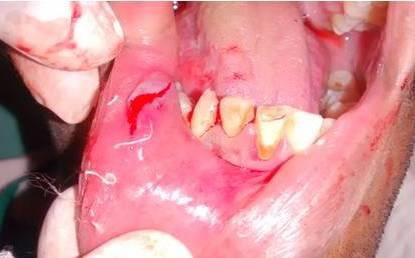 Figure 3: Cystic lesion separated from the underlying mucosa and connective tissue with hemostasis achieved.