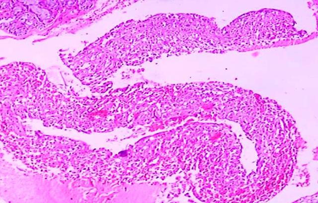 Figure 5: Histopathological examination with H & E stained section revealing lesional tissue to be composed of minor salivary gland tissue with pooled mucinous areas and chronic inflammatory cell infiltration.