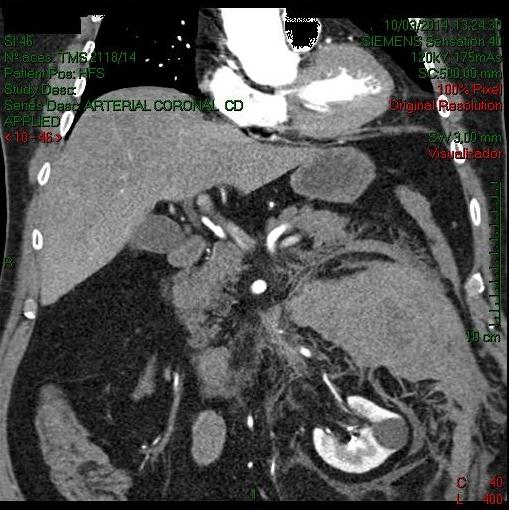 Figure 2: CT of the abdomen in coronal section with venous contrast showing a hematoma in the retroperitoneum displacing the left kidney inferiorly.