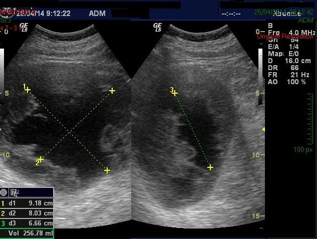 Figure 4: Control ultrasonography showing retroperitoneum collection in phase of resorption.