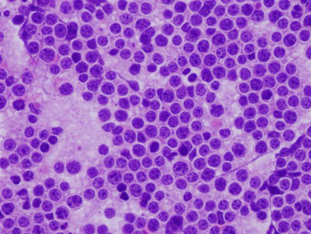 Figure 1: Burkitt's Lymphoma- monotonous round cell infiltrate.