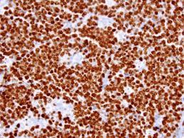 Figure 10: Burkitt’s Lymphoma - Nuclear reactivity for Ki67.