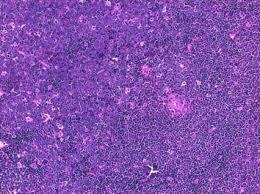 Figure 5: Burkitt's Lymphoma- intra-cytoplasmic vacuoles, chromatin dispersal.