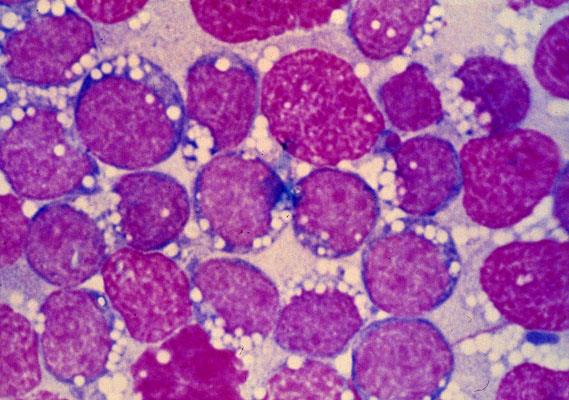 Figure 8: Burkitt's Lymphoma with a round cell exudation –papanicolaou stain.