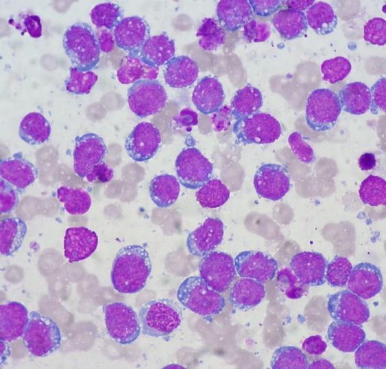 Figure 9: Burkitt's Lymphoma: intra-cytoplasmic vacuoles and monomorphic nuclie- aspiration cytology.