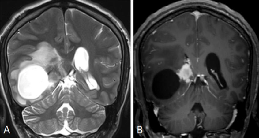Figure 2: Coronal T2 weighted image (A) and Gadolinium enhanced T1 (B): nodular lesion is in contact with the ventricular atrium.