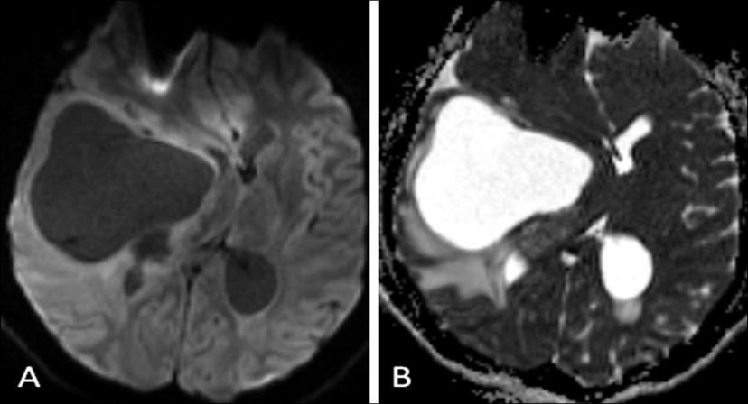 Figure 3: Diffusion imaging B1000 (A), ADC cartography (B): nodular part of the lesion is hyposignal in diffusion imaging, with high ADC (1,06 x 10-3 mm²/sec) while cyctic part signal was similar to CSF.