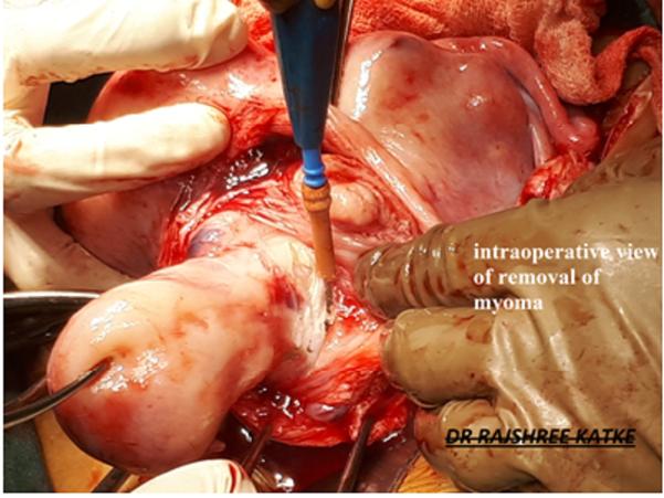 Figure 1: Intraoperative view of removal of myoma.