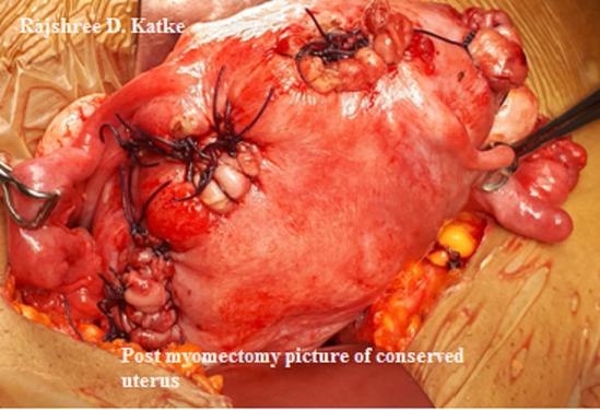 Figure 2: Post myomectomy picture of conserved uterus.