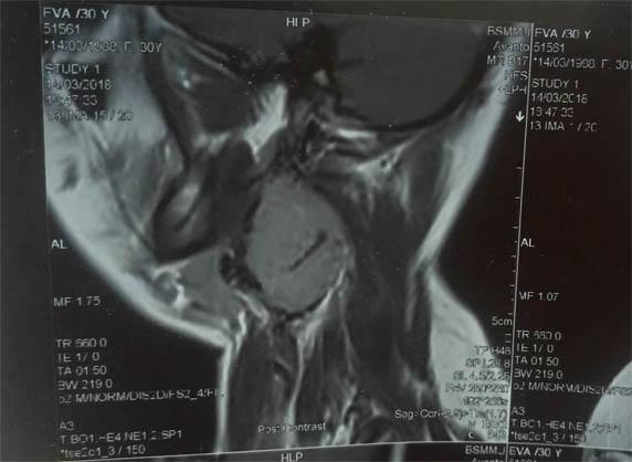Figure 1: MRI of the patient showing an enhancing mass in neck.