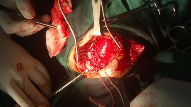 Figure 2: During operating procedure dissection of the paraganglioma.