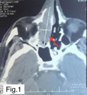 Figure 1: Axial CT scan slide showing the right paranasal tumor.