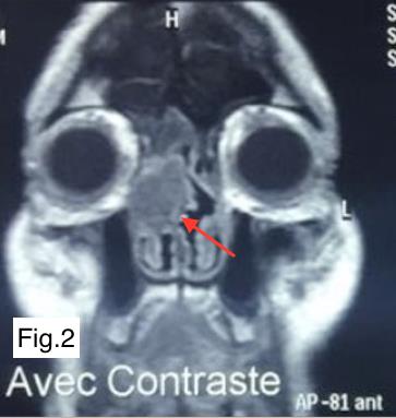 Figure 2: Coronal MRI slide showing the right paranasal tumor with close contact to the right orbit (red arrow).