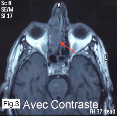 Figure 3: Coronal MRI slide showing the right paranasal tumor with close contact to the right orbit (red arrow).