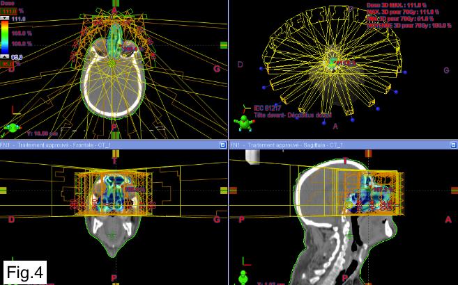 Figure 4: Disposition of multiple IMRT beams on the three plans (axial, sagittal and coronal).
